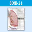 Плакат «Рак легких» (ЗОЖ-21, пластик 2 мм, A1, 1 лист)
